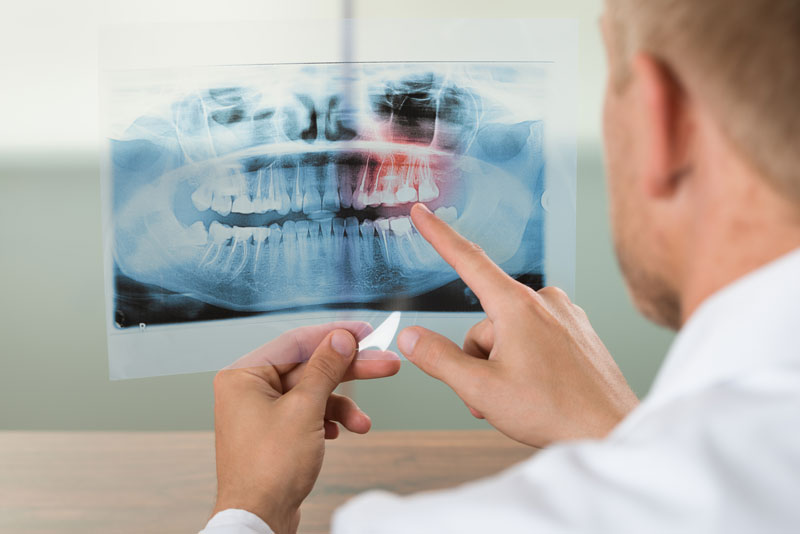 Clínica Dental Willson en Vigo tratamientos endodoncia