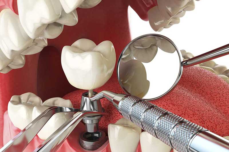 Clínica Dental Willson en Vigo tratamientos implantes dentales