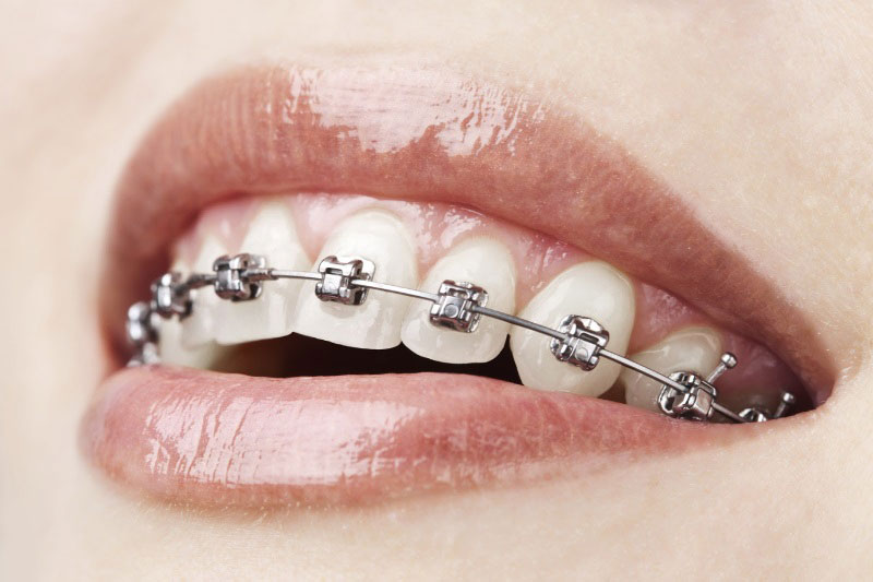 Clínica Dental Willson en Vigo tratamientos ortodoncia bráckets