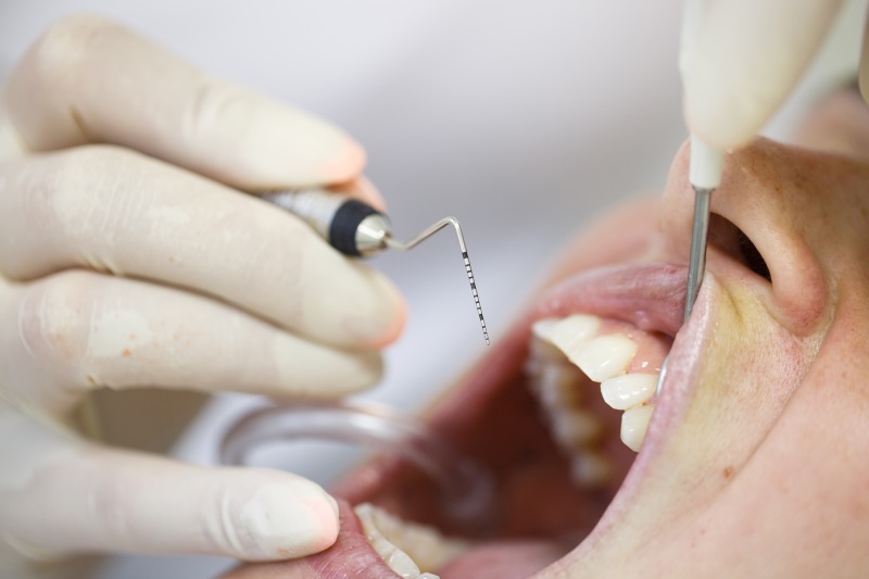 Clínica Dental Willson en Vigo tratamientos periodoncia