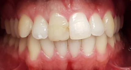 Casos Clínicos Estética Dental antes