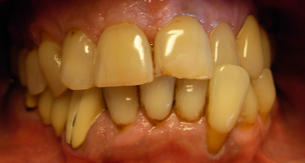 Casos Clínicos Estética Dental Cristina antes