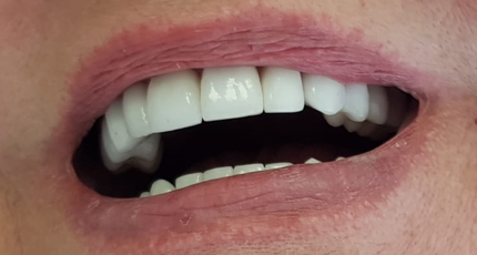 Casos Clínicos Estética Dental Cristina después