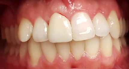 Casos Clínicos Estética Dental después