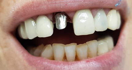 Casos Clínicos Implantes Dentales antes