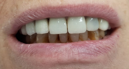 Casos Clínicos Implantes Dentales después