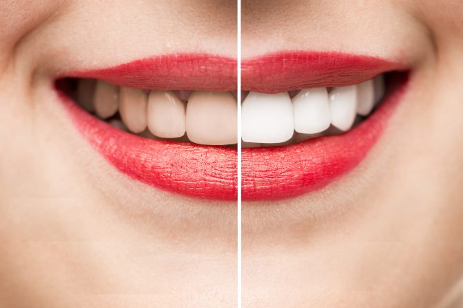 ¿Es posible eliminar las manchas del esmalte dental?