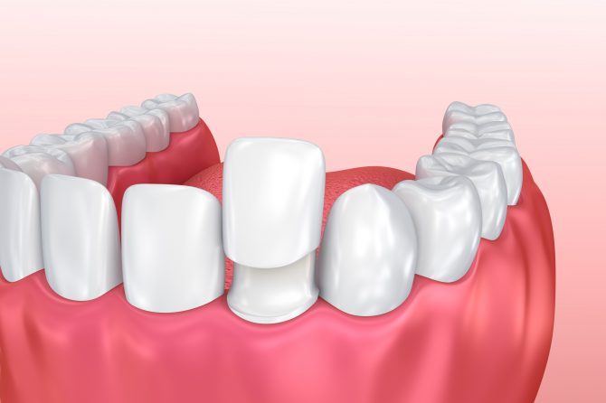 ¡Elige los mejores implantes dentales!