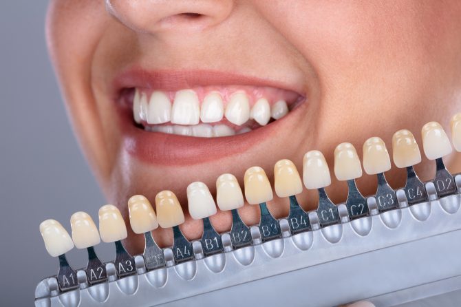 Carillas dentales: todo lo que debes saber
