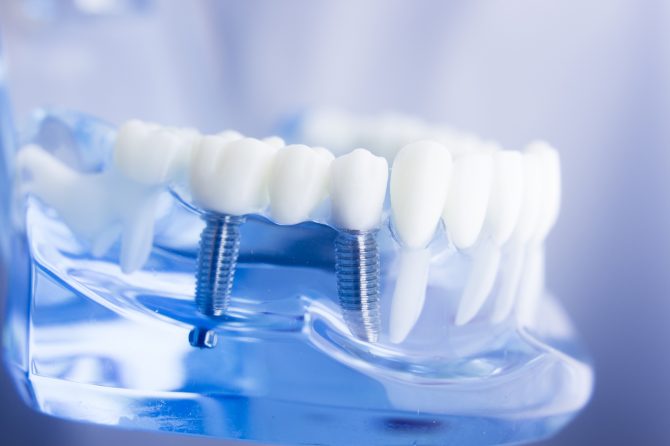 ¿Cómo funciona la periimplantitis?