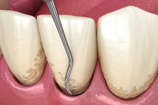 Curetaje dental: todo lo que debes saber