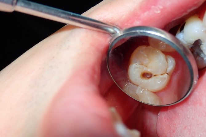 Fases de evolución de la caries dental
