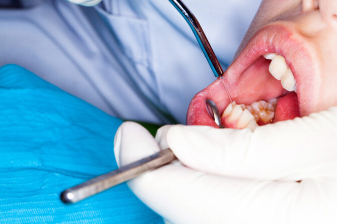 ¿Qué hacer después de un tratamiento periodontal? Consejos de cuidado postoperatorio