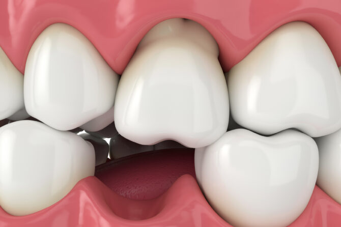Avulsión dentaria: qué hacer en caso de pérdida de un diente y cómo salvaguardar tu sonrisa